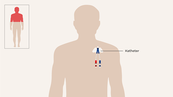 Illustratie van een katheter in de hals.