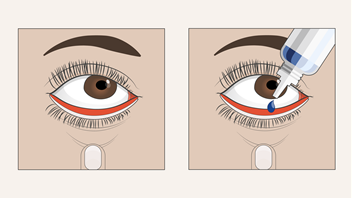 Illustratie die weergeeft hoe oogdruppels toegediend moeten worden.